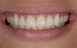 Figure 17  The postoperative smile. Note full contours and length.