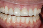 Figure 18  Postoperative retracted. Note incisal embrasures length and tissue health.