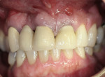 Figure 1  The patient presented with a suppurative fistula apical to the maxillary left central incisor.