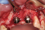 Figure 8  At the second-stage surgery, Encode Healing abutments were placed.