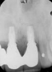 Figure 9  Postoperative radiograph confirmed that the alveolar crestal height was maintained.