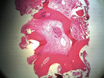 Figure 11  Histologies from regenerated sites at 6 months. Low-power microscopic examination revealed new bone formation in conjunction with a number of unresorbed xenograft particles (hematoxylin and eosin [H&E] stain; original magnification x10