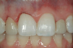 Figure 13  The same patient after apical repositioning of the gingival margins for the right lateral and central incisors and incisal lengthening of the left central incisor.