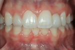 Figure 14  A 6-month postoperative view of the gingival surgery. It also shows the appearance of the right lateral incisor porcelain veneer and the left lateral incisor pontic of the etched PFM resin-bonded retainer. Note that the apical third of the