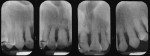Figure 4  Severe bone loss localized to maxillary anterior sextant is seen here in a patient with T21, similar to the patterns seen in other forms of aggressive periodontitis.