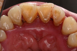 Figure 6  The inflamed palatal tissue of this patient, who initially presented with spontaneous bleeding.