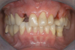 Figure 2  Extraction of fractured teeth Nos. 7 and 11.