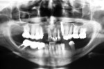 Figure 3  Panoramic radiograph after tooth extraction and implant placement.