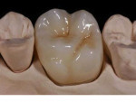 Figure 13  A milled e.max full-contour posterior restoration, shown in the final 