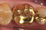 Figure 4  Preoperative clinical condition of a gold crown with a perforation in the occlusal surface.