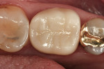 Figure 6  IPS e.max CAD crown at the 3-year recall evaluation.
