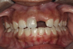 Figure  1 Anterior view demonstrating the missing maxillary left central incisor.
