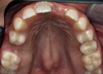 Figure  2 Occlusal view demonstrating the inadequate contour of the ridge.