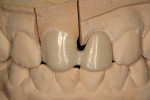 Figure  12 Labial view of the zirconia framework on the model.