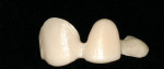 Figure  13 Zirconia framework demonstrating contour and connector size to support overlying porcelain.