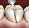 Fig 12. An onlay was placed on tooth No. 30.