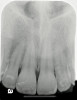 Fig 3. Clinical view of a maxillary left second premolar in an 73-year-old patient with a history of smoking. The tissue around the implant is quite inflamed and probes up to 8 mm with bleeding.