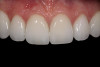 Fig 1. Clinical view of maxillary left lateral incisor implant in a healthy 48-year-old man. The swelling in the tissue surrounding this implant also bled on probing with depths up to 8 mm and exhibited purulence. The implant has been present for 14 years.