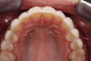 Fig 6. Clinical view of this area suggests that peri-implant mucositis is present, as there is bleeding on light probing and inflammation of the tissue.