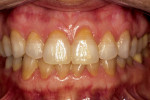 Figure  10  No gingival recession is evident.