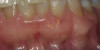 Fig 9. Intraoral view of the titanium bridge framework with individual lithium-disilicate crowns.