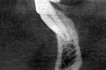 Figure  1  Sagittal section through tooth No. 22. Diagnostic calibrated digital photograph.
