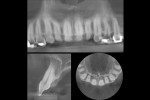 Figure  8  Collage of tooth No. 7.