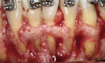 Figure  18  Fenestrations without gingival recession.