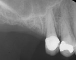 Figure  4  Preoperative radiograph of the No. 3 area.