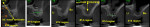 Figure  5  CBCT images of the maxillary left posterior region.