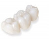 (12.) A patient presented with advanced generalized wear of her anterior teeth, and was displeased with their overall appearance because of their color and wear.