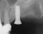 Figure  7  Radiograph of implant No. 14 after sinus elevation.
