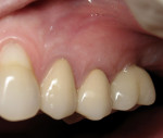 Figure  9   Left molar 1 year after implant placement reveals good gingival contour and esthetics.