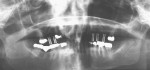 Figure  13  Preoperative panoramic film with radiographic markers.