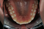 Figure  2  Initial occlusal maxillary view.