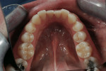 Figure  3  Initial occlusal mandibular view.