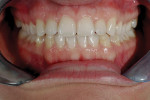 Figure  5  At the completion of Invisalign<sup>®</sup> treatment 16 weeks, intraoral anterior view. Notice the coinciding midlines.