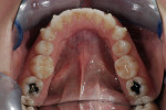 Figure  7  At the completion of Invisalign<sup>®</sup> treatment 16 weeks, occlusal mandibular view. Notice the alignment of the lower incisors.