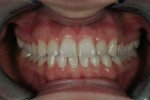 Figure  10  Final intraoral view at 18 weeks. Notice the satisfactory incisors angulations and coinciding midlines.