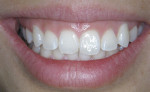 Figure  1  Preoperative view of the patient’s chipped central incisors, with excessive gingival display evident.