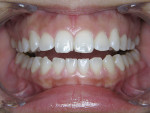 Figure  2  Retracted view emphasizing chip on the right central incisor caused by the patient’s pen chewing habit in her school years.