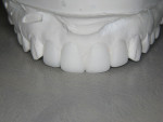 Figure  5  View of the waxed up model of the anterior teeth.