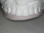 Figure  6  The putty matrix was created to indicate the ideal incisal edge position.