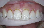 Figure  10  A1 Dentin, A1 Enamel, and Trans 30 shades of IPS Empress Direct composite were layered to mimic the optical characteristics of the patient’s natural tooth structure.