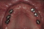 Figure  8  Occlusal view of maxillary implants with impression analogs.