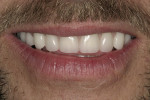 Figure 13  Postoperative up-close smile.