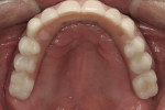 Figure  15: Postoperative maxillary occlusal view.