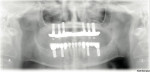 Figure  16  Postoperative full-mouth radiographs.