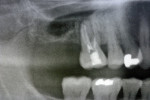 Figure  1  Panoramic close-up radiographs of the maxillary molars on presentation and implant consultation.