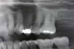 Figure  2  Panoramic close-up radiographs of the maxillary molars on presentation and implant consultation.